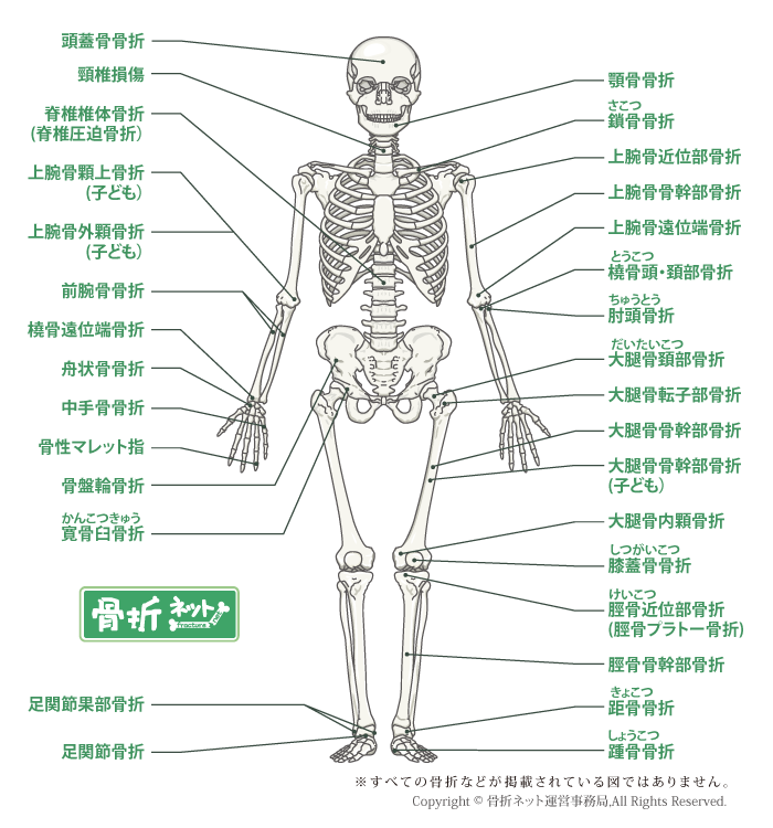 骨折マップ